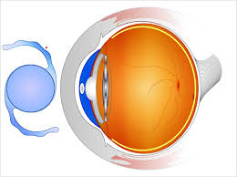 what are intraocular lenses made of