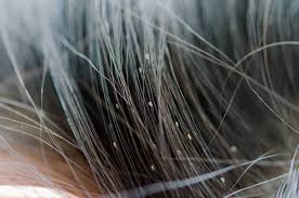 how to get rid of nits and lice in hair