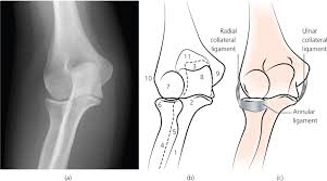 Medial epicondyle apophysitis, often called little league elbow, is the most common injury affecting young baseball pitchers whose bones have not yet stopped growing. Elbow Radiology Key