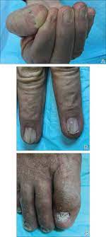 nail patella syndrome clinical clues