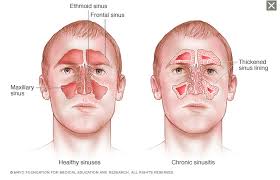 are your sinuses healthy is mold the