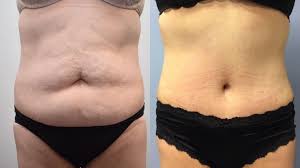 After a tummy tuck, an individual may need help caring for young children for several weeks to months. Tummy Tuck For Latham Albany Ny Rockmore Plastic Surgery