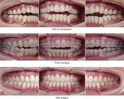 bimaxillary dental protrusive growth