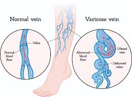 varicose veins treatment in mrc nagar