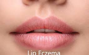 lip eczema lip dermais how to deal