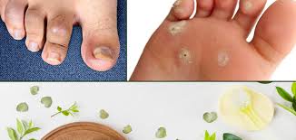 don t know about nail psoriasis get