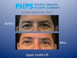 recover from eyelid surgery