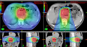 radiation therapy for pancreatic cancer