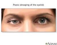 what-causes-an-eyelid-to-droop