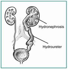 what is hydronephrosis