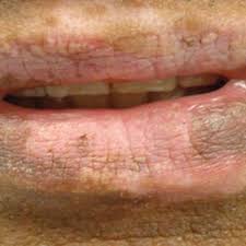 herpes lis induced lip leukoderma