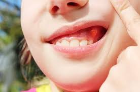 The formation of an abscess on the baby's gums signals a serious inflammation or injury.do not ignore the appearance of the tumor, and if it is found, you discontinue oral care.to clean a teeth to the kid it is necessary during illness, only accurately; Dental Cyst And Infection Causes Symptoms And Treatment Dentist In San Rafael Ca