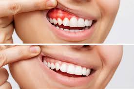 treating periodontal disease all you
