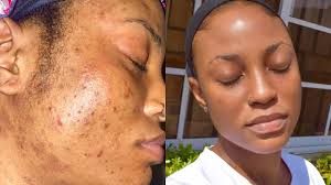 skincare routine for oily acne e