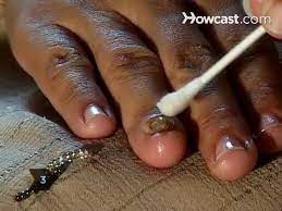 how to cure nail fungus you
