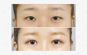 eyelid surgery recovery process tips