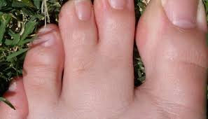 webbed toes causes symptoms and