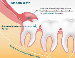 wisdom tooth extraction impacted tooth