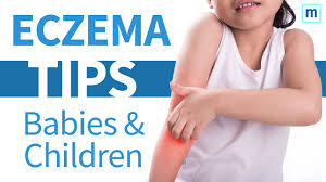 eczema in es and children la