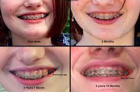 People need braces for different reasons, which also means there are different types of braces. Is My Orthodontist Doing Something Wrong Braces
