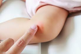 skin rash treatment how to stop the itch