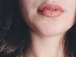 chapped lips symptoms causes and