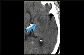 The Radiology Assistant Brain Ischemia Imaging In Acute