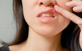 recur mouth ulcers and canker sores