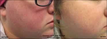 rosacea treatments from the connecticut