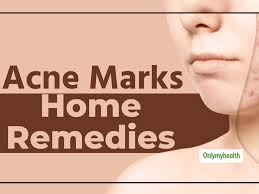 home remes to treat acne scars