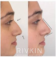 Asian non surgical rhinoplasty (and cheek and chin and lip fillers) full profileplasty. Westside Aesthetics Non Surgical Nose Job Nose Job Nose Fillers Rhinoplasty Nose Jobs