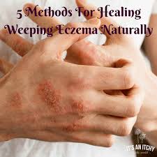healing weeping eczema naturally