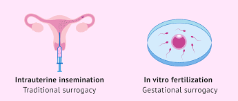 Assisted Reproductive Technology (ART) - Techniques Used in Surrogacy