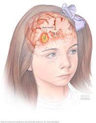 A brain tumor can cause symptoms by directly pressing on the surrounding parts of the brain that control certain body functions, or by causing a buildup of spinal fluid and pressure throughout the brain (a condition known as hydrocephalus). Pediatric Brain Tumors Symptoms And Causes Mayo Clinic