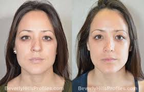 We did not find results for: Rhinoplasty Before After Photos At Beverly Hills Profiles