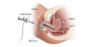 uterus removal surgery operation