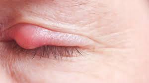 eyelid pain 5 reasons eyelids hurt