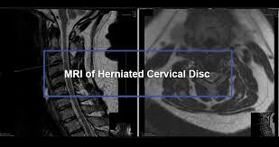 mri of herniated cervical disc dr