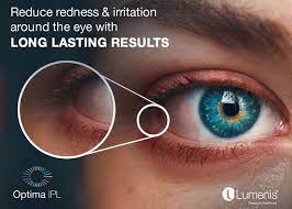 ipl advanced dry eye treatment o