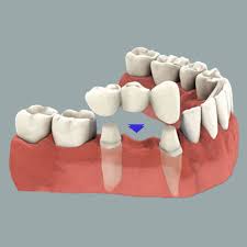 Dental Bridges Guide : Pros Cons, Side Effects, Scars and After Care