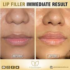 lip augmentation lip surgery cost