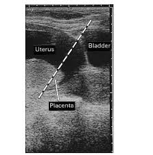 Lover of women, adventure and mystery. Placenta Previa Types Grades Causes And Treatment Jotscroll