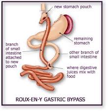 Gastric Bypass Surgery Gainesville Ga The Longstreet