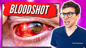 bloodshot eyes what causes bloodshot