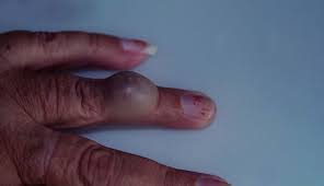 mucous cysts treatment hand doctor in