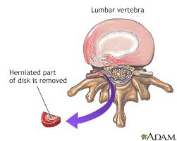 herniated disk information mount