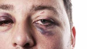 how to get rid of a black eye chicago il