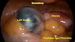 I have a large overian cyst 11 x 9 x 8 cm on one overy and on the other overy a 5cm one. Big Ovarian Cyst 8cm Ooforectomy Ligasure Youtube