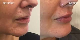 lip fillers london from 111 harley st