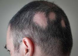 Alopecia areata is an autoimmune disorder characterized by the rapid onset of hair loss in a sharply defined area. What Is Alopecia Areata Hair Loss Almirall